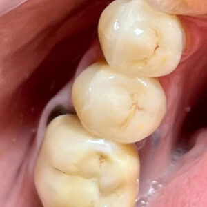 שיחזור שיניים