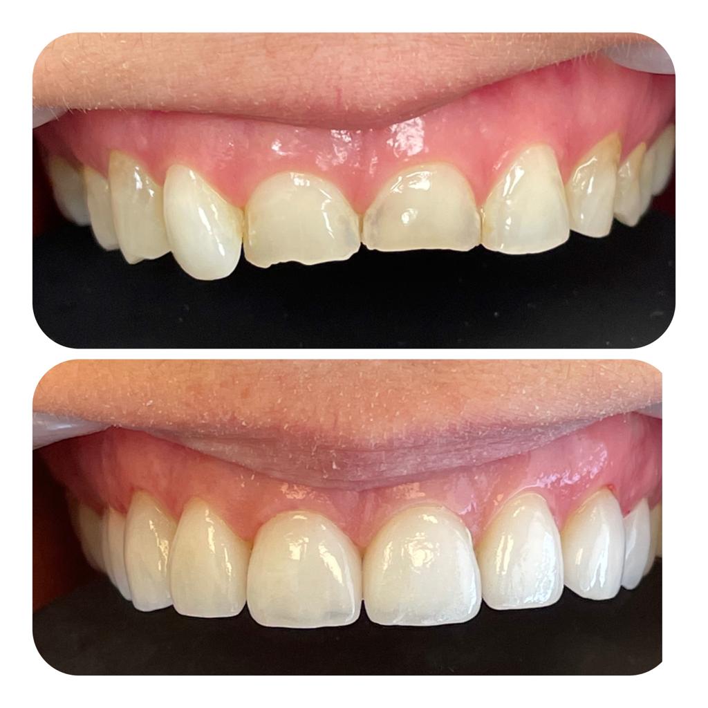 שיניים שבורות לפני ואחרי