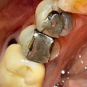 אינליי ואונליי שיחזור שיניים במרפאת שיניים בנס ציונה ד"ר אבנרי ליאור