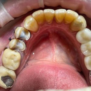 אינליי שיחזור שיניים מרפאת שיניים ד"ר אבנרי ליאור