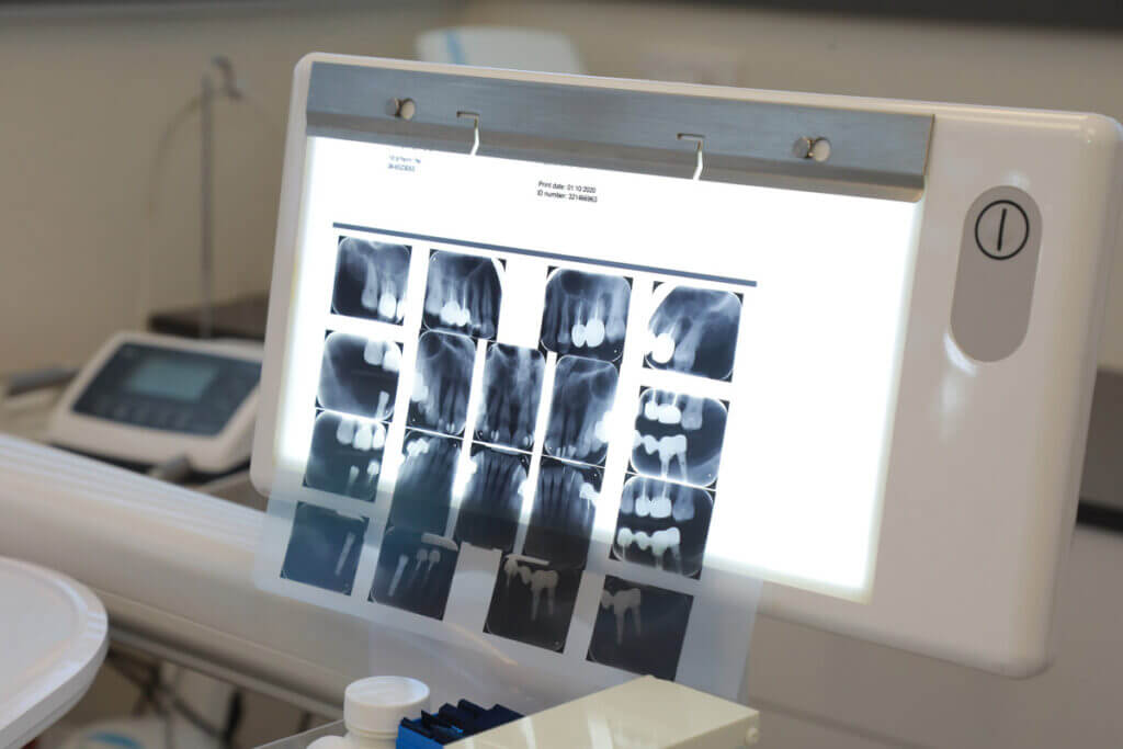 טיפולי שורש - טיפול להצלת השיניים בעקבות מגוון נזקים. הטיפול אצלנו ניתן על ידי רופא שיניים בנס ציונה ד"ר אבנרי ליאור