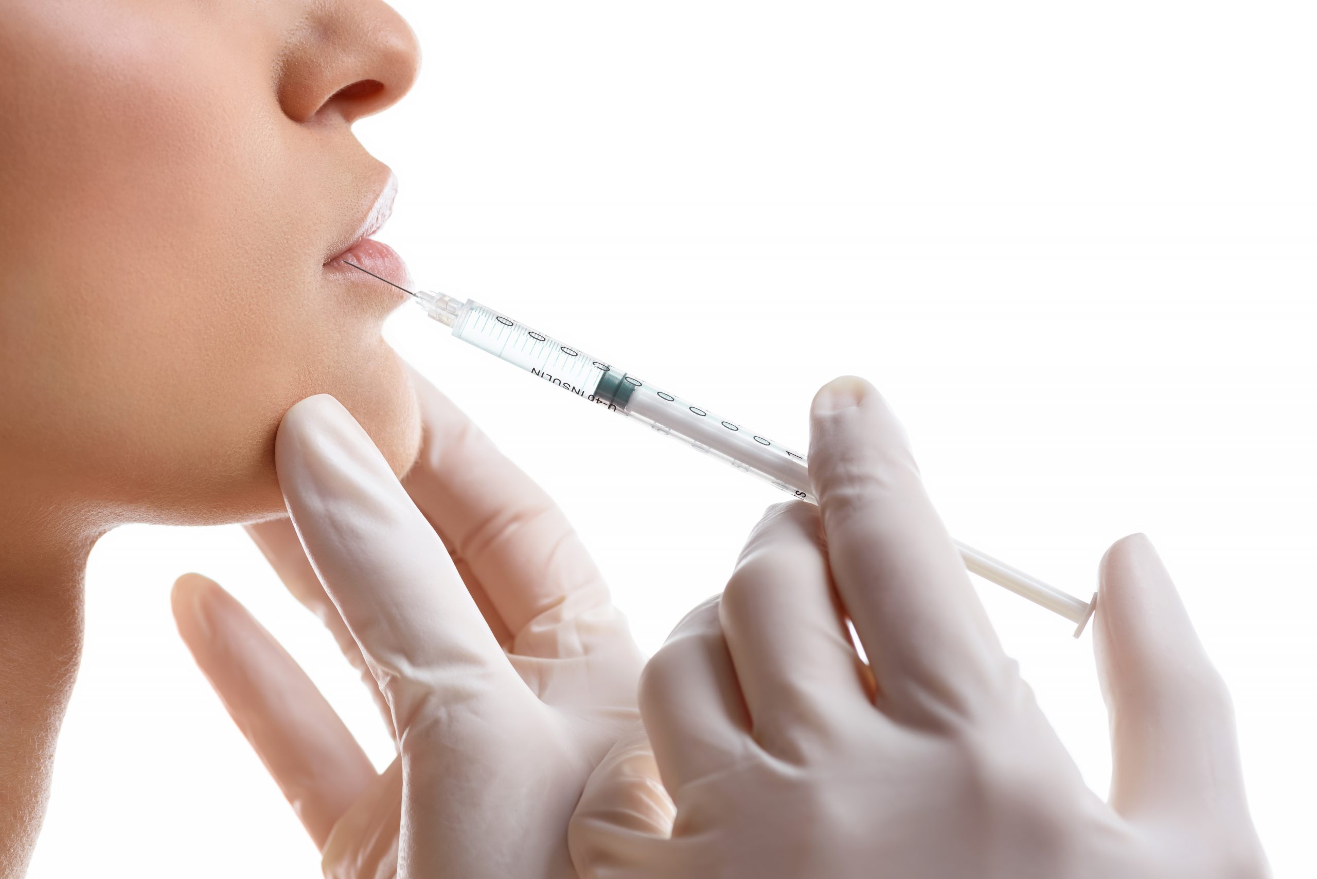 עיבוי שפתיים - רופא שיניים נס ציונה ד"ר אבנרי ליאור